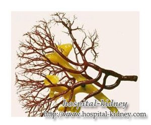 چگونه برای درمان FSGS کراتینین بالا