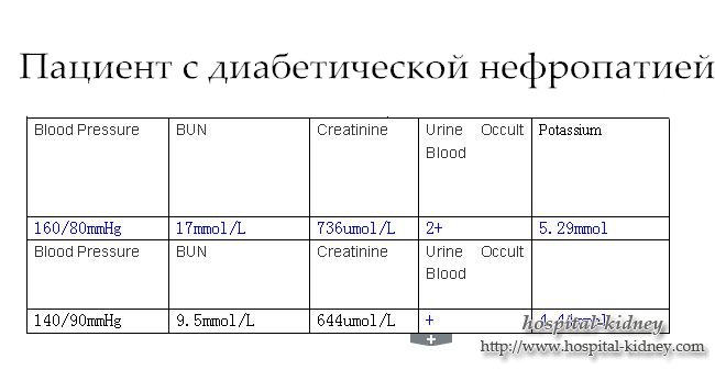 Пациент с диабетической нефропатией в Больнице Нефропатии Шицзячжуана